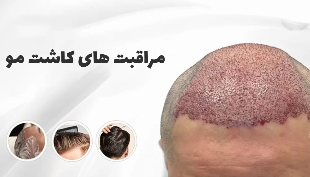 پرسش بیست و یکم: آیا می‌توان قبل از کاشت مو موها را رنگ کرد؟