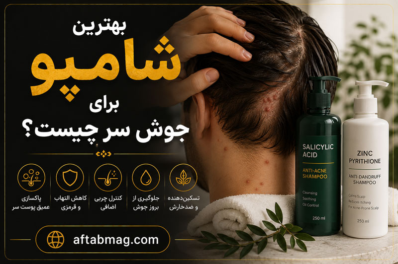 بهترین شامپو برای جوش سر چیست؟ راهنمای انتخاب شامپوی مناسب برای پوست سر جوش‌دار