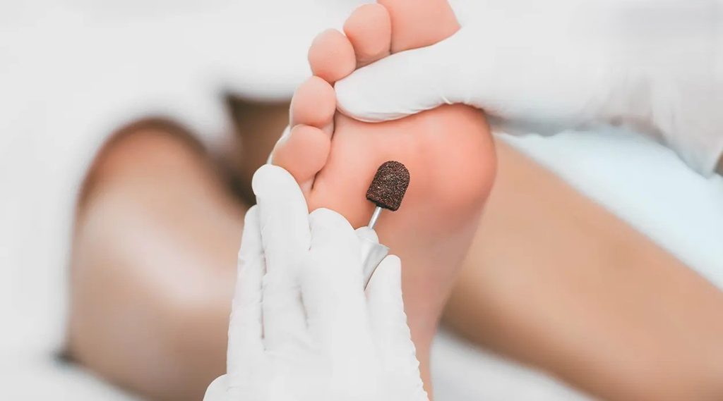بهترین روش پیشگیری از میخچه